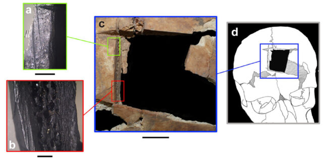 diagram of Meggido grave skull with trepanation marks