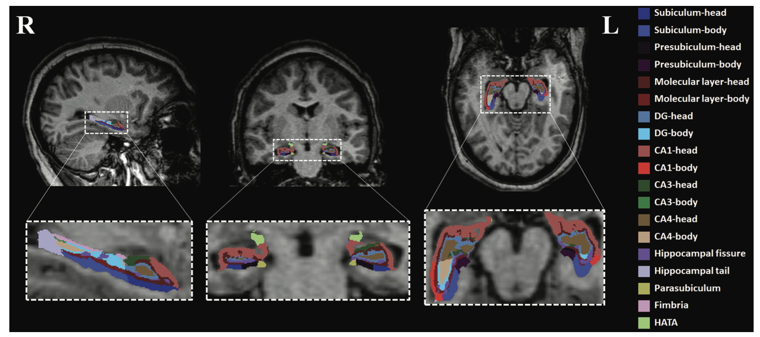 There's Something Different in The Brains of Teens With Sleep Apnea