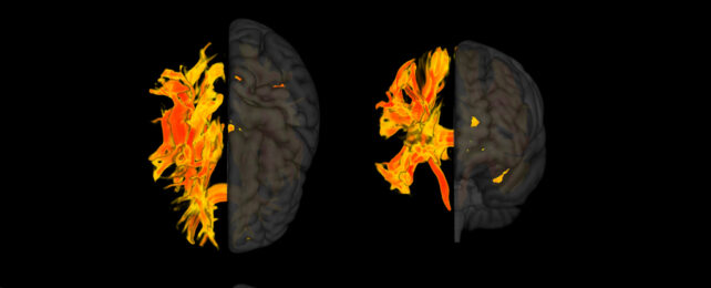 heat map showing most impacted brain regions in red