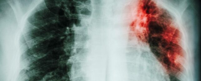 Tuberculosis Deaths Creep Upwards After Falling For Decades in Europe