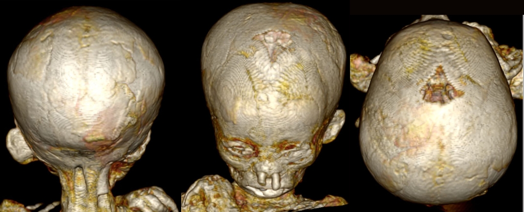 Three images side by side of different angles showing 3D volume rendering reconstruction of the skull of one of the children.