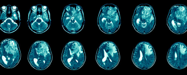 Glioblastoma in the human brain