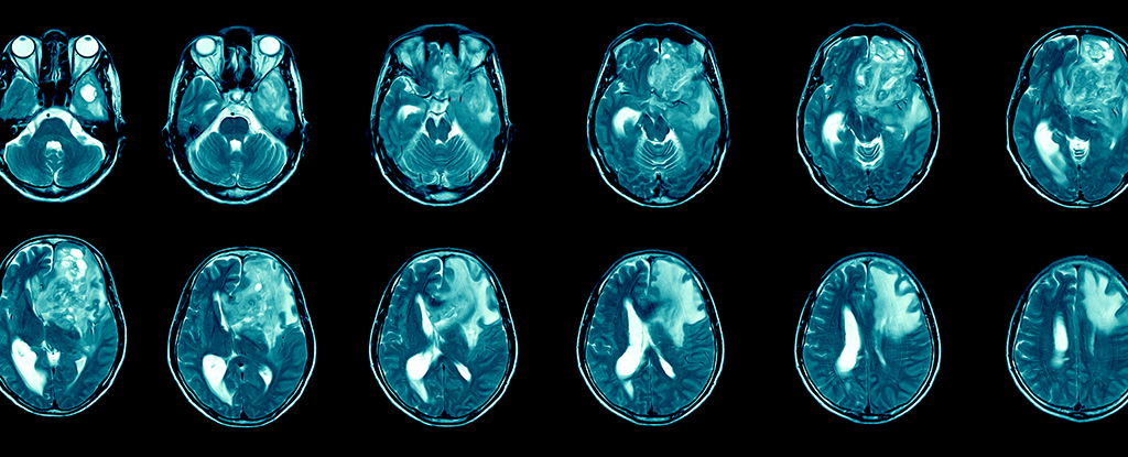 Un hidrogel recientemente desarrollado puede acabar con el cáncer de cerebro en ratones : Heaven32