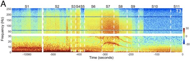 Graph showing burst of brain activity at high frequencies in red, against a blue background of normal activity.