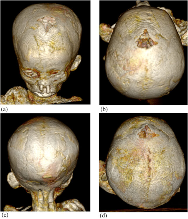 4 differently angled images showing 3D volume rendering reconstruction of the skull of case 2.