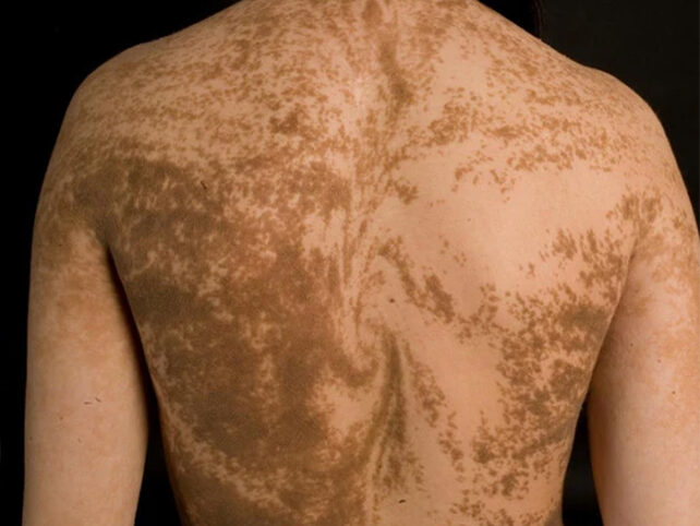 Espalda de mujer con remolinos pigmentados oscuros sobre piel clara.