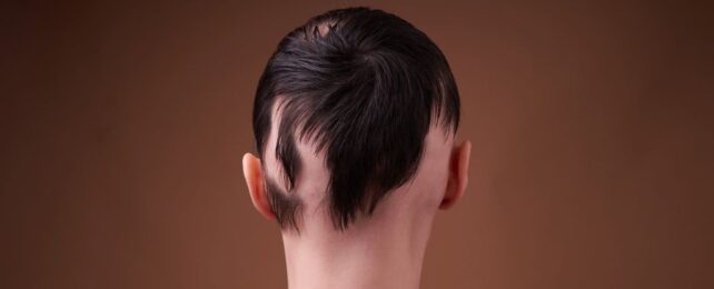 New Hair Loss Drug Approved: Restores 80% of Hair Loss In Some Alopecia Patients