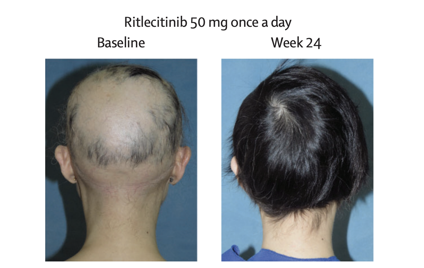 New Hair Loss Drug Approved Restores 80 of Hair Loss In Some Alopecia