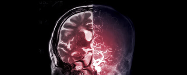 MRI compared to angiogram showing cerebral artery from front of brain.