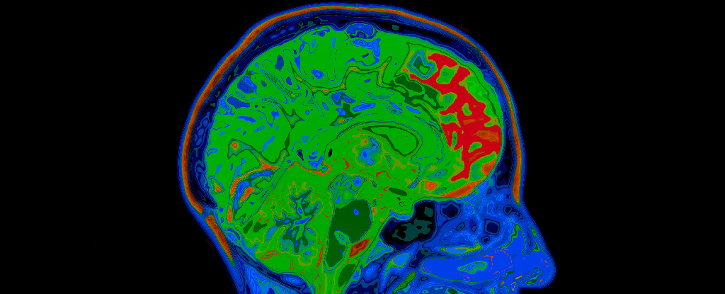 Obezita môže vyvolať trvalé zmeny v reakcii mozgu na živiny, štúdia: ScienceAlert