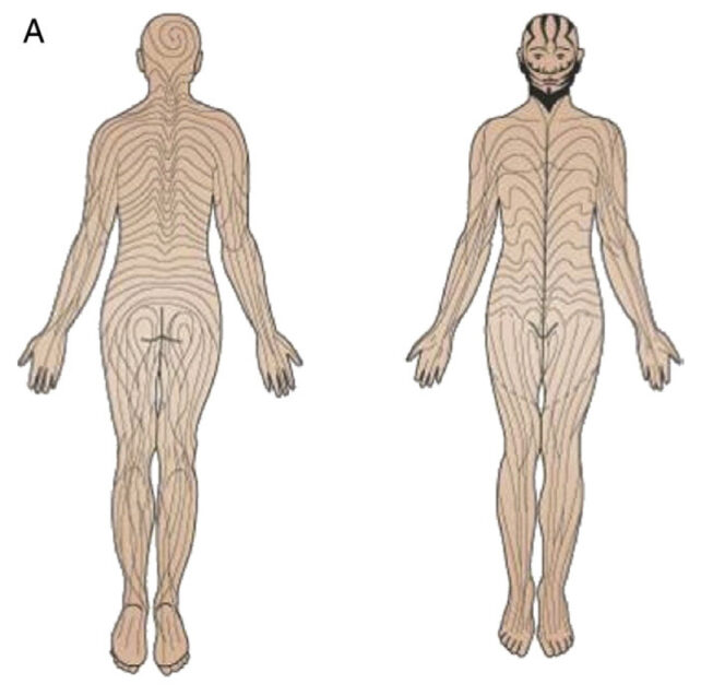 Diagram showing Blaschko Lines on front and back of human body