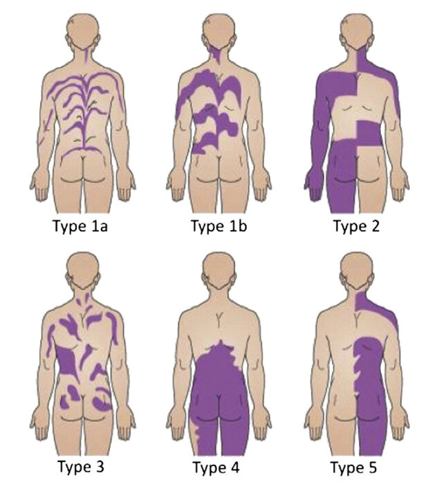 Diagram showing different patterns of mosaicism in humans