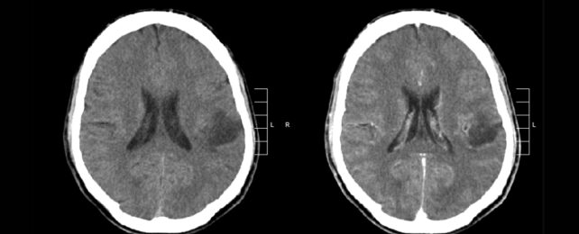 Two side by side CT scan images of a brain on a black background