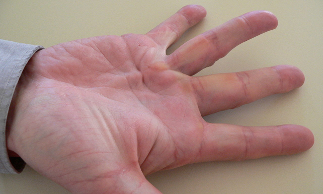 A human hand with Dupuytren's contracture.