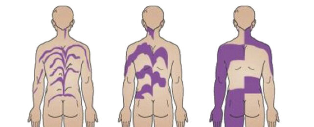 Human patterns of mosaicism.