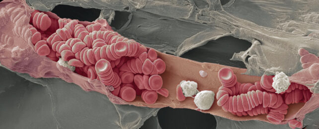 Red and white blood cells sitting in a tiny ruptured vein.