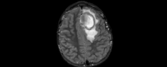 Abnormal Surge of Brain Abscesses in American Children, CDC Says