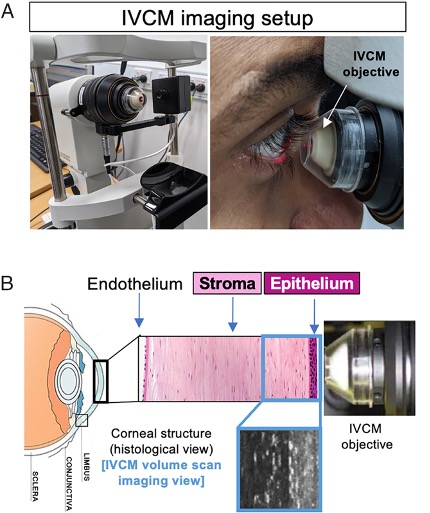 Diagram showing set-up of eye imaging method used in the study, and the three layers of the cornea (endothelium, stroma and epithelium).