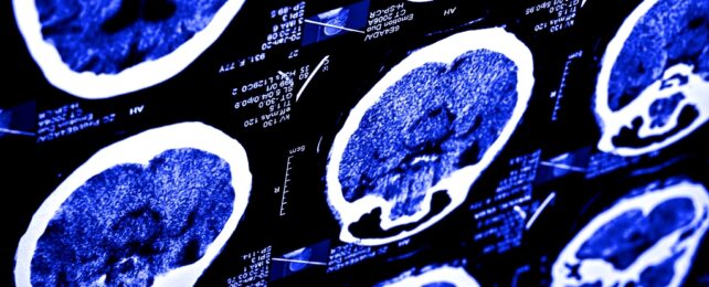MRI Scans Of Brain