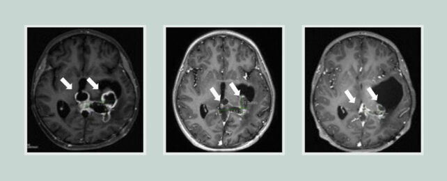 Cancer brain scans