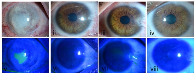 Corneal surface before and 3, 6 and 9 months after CALEC transplant
