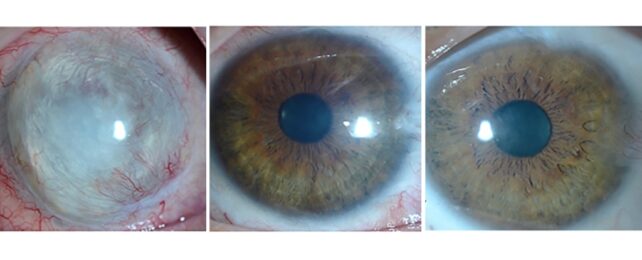 An injured eye before and after treatment