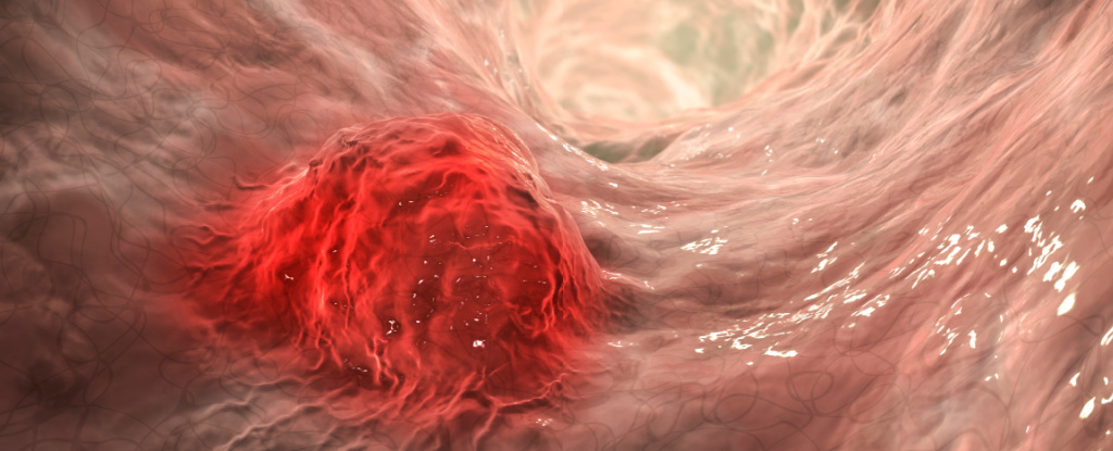 IntestinalCancerFormingInColon