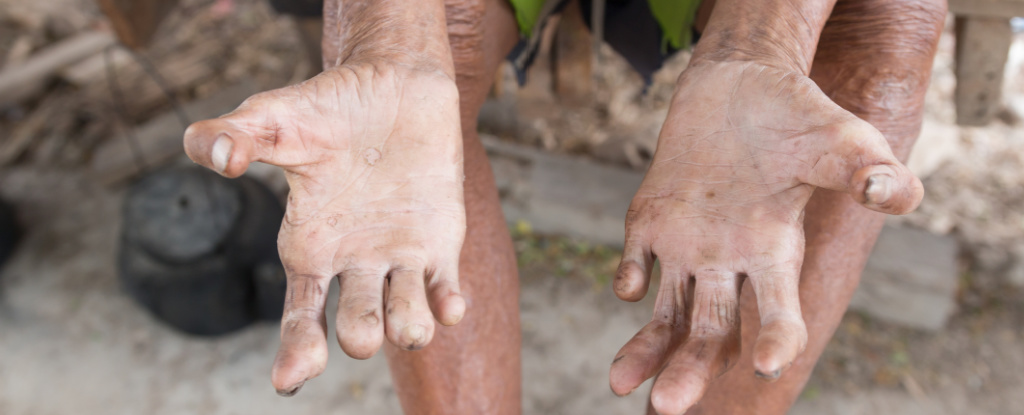 LeprosyManHands