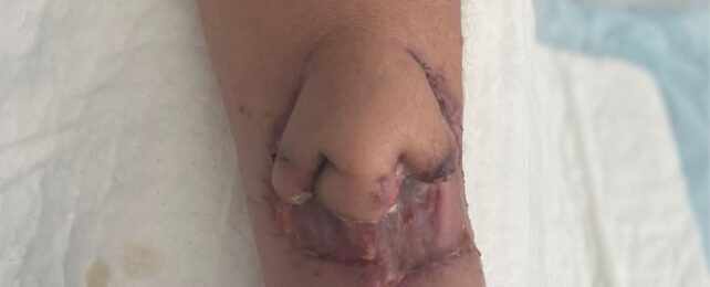Surgeons 3D-Printed a New Nose, And Then Attached It to The Patient's Arm