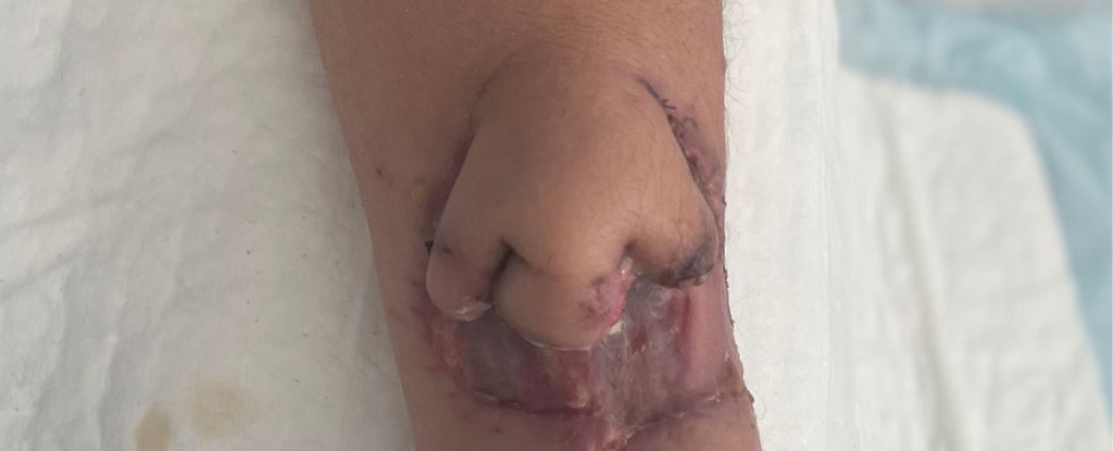 NoseTransplant 1