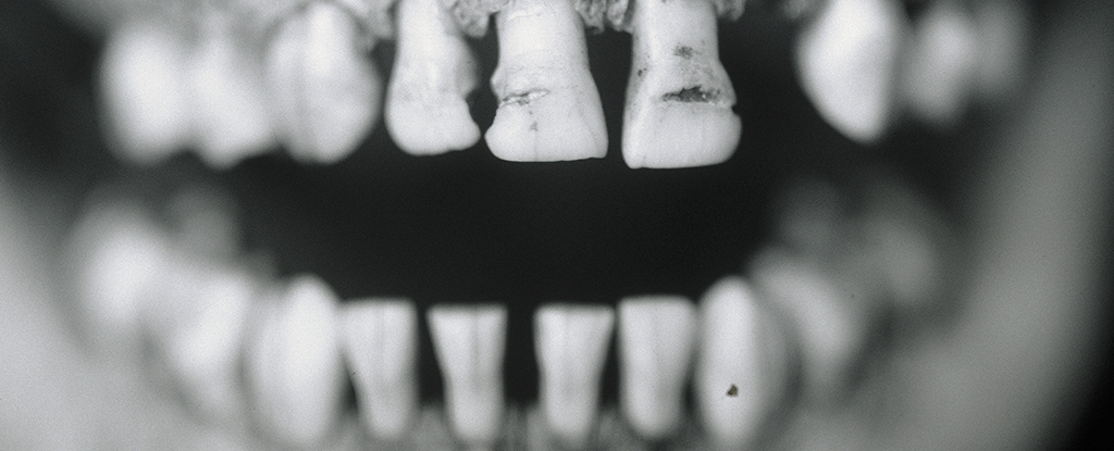 Studio: i denti possono continuare a segnalare agenti patogeni per centinaia di anni