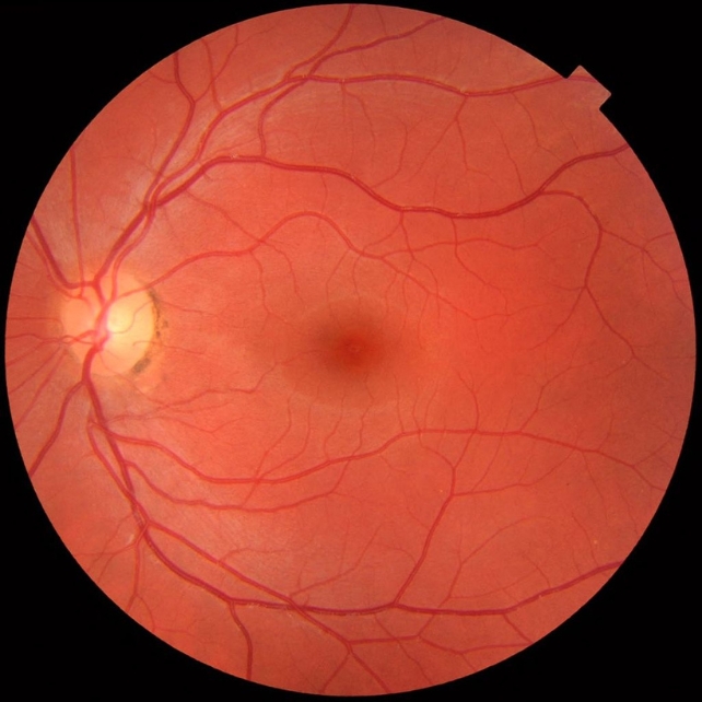 A photo of the rear of an eye, showing the optic nerve. 