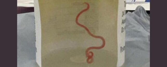 Surgeons Pull a Live Roundworm From a Woman's Brain In Horrific First