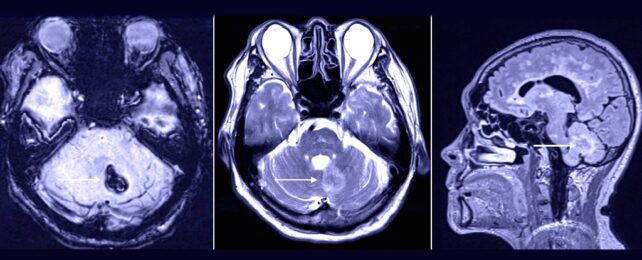 three perspectives of a CT scan of patient's brain