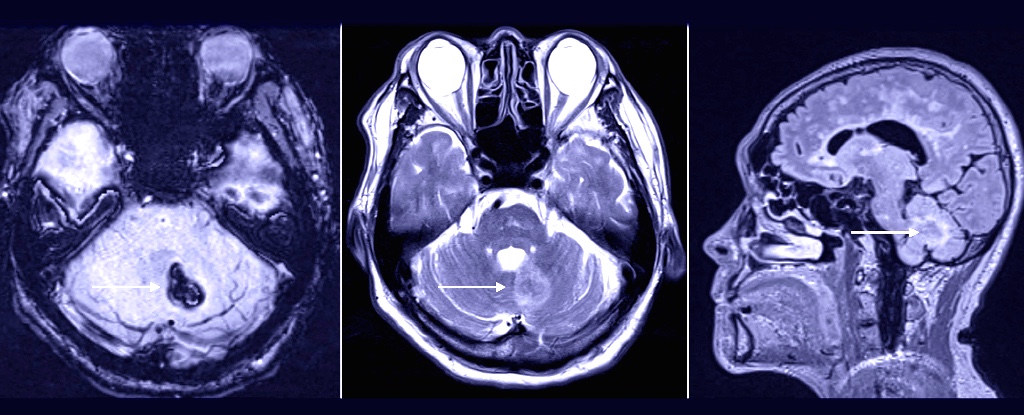 Dentist Visit Might Have Triggered Rare Brain Bleed in Patient - ScienceAlert