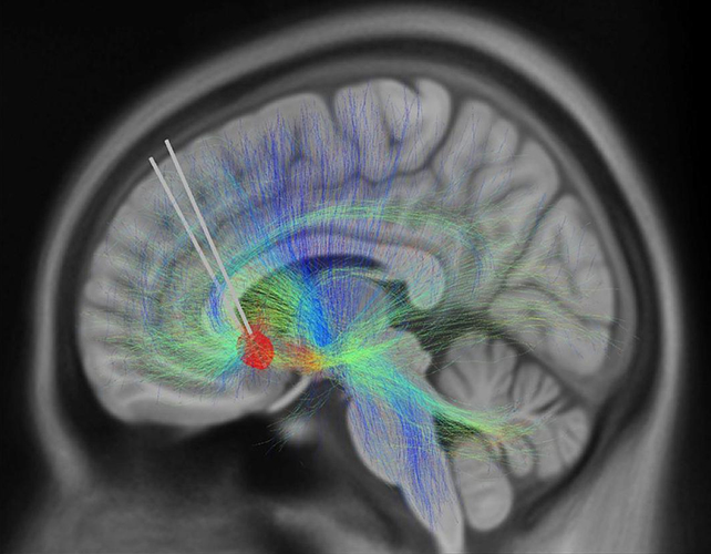 Brain implant scan