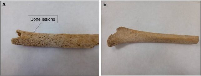 Two images showing a long, slender thigh bone with lesions, and another unmarked femur.