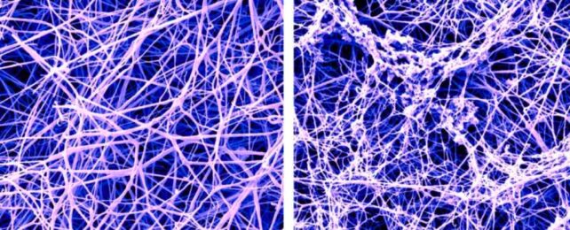 A false-color scanning electron microscope image of a fibrin blood clot before and after the buildup of amyloid-beta proteins called protofibrils.