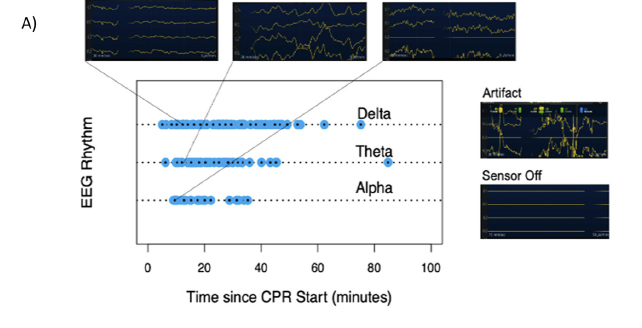 eeg recording for up to an hour after cpr