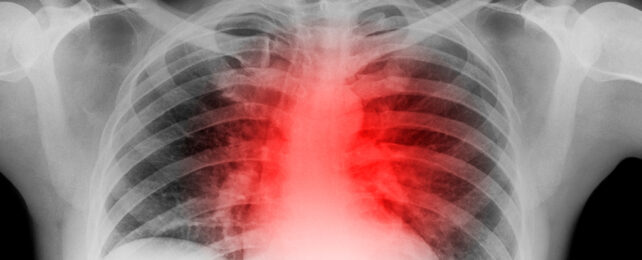 red tinted heart in an xray of a chest