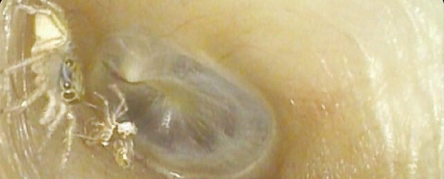 Translucent spider inside ear canal.