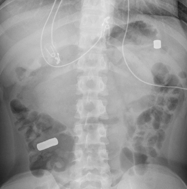x-ray of adolescent with bright objects in stomach and intestine