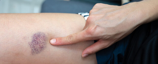 Do You Bruise Easily? It Could Be A Sign Of Something More Serious
