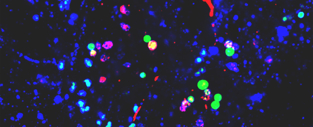 Study: Nanoplastics linked to changes in brain proteins associated with Parkinson’s disease