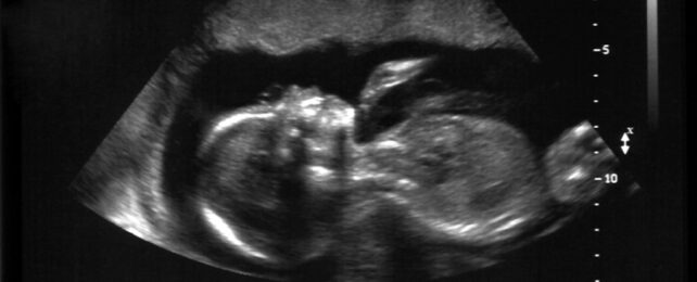 Ultrasound image of a baby