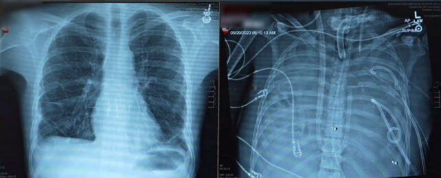 x-rays of patient chest with lungs and lungs removed