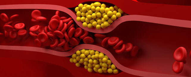 Narrowed artery illustration