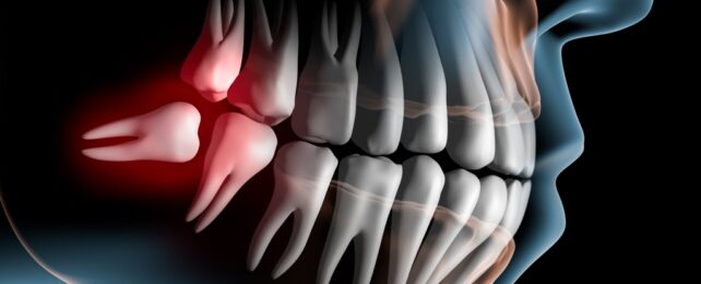 Illustration Of Wisdom Teeth Inside Mouth