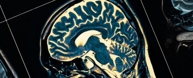 MRI brain scan of a person's head, in profile.