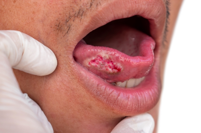 a person's tongue showing red and white spots 
